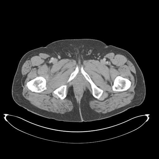 Adenocarcioma of rectum- T1 lesion (Radiopaedia 36921-38547 Axial C+ portal venous phase 94).png