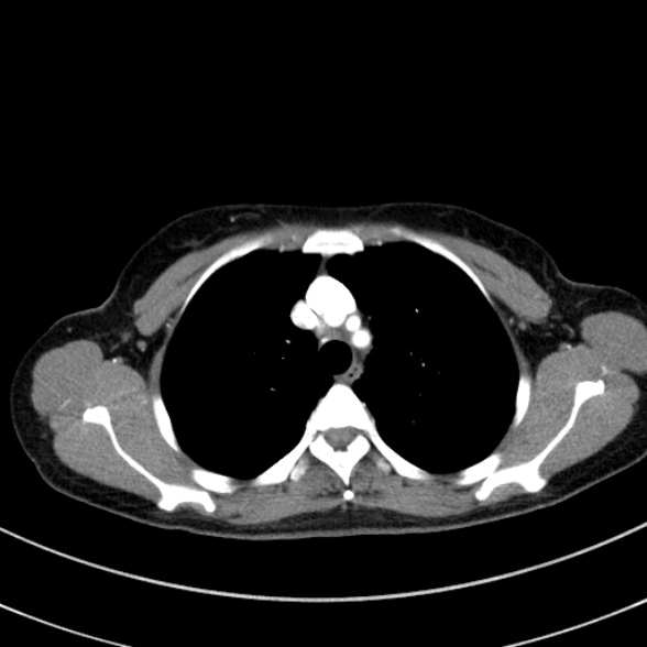 Adenocystic carcinoma of the trachea (Radiopaedia 47677-52525 Axial C+ arterial phase 39).jpg