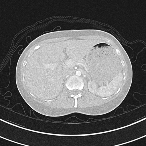 Adenocystic carcinoma of the trachea (Radiopaedia 47677-52525 Axial lung window 80).jpg