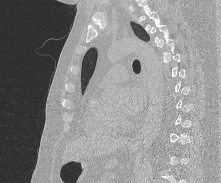 Adenoid cystic carcinoma of the trachea (Radiopaedia 49042-54137 Sagittal lung window 265).jpg