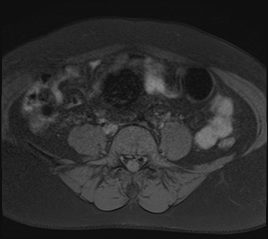 File:Adenomyosis - ovarian endometriomas (Radiopaedia 67031-76350 Axial T1 fat sat 3).jpg