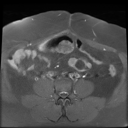 File:Adenomyosis within a didelphys uterus (Radiopaedia 70175-80215 Axial T1 C+ fat sat 10).jpg