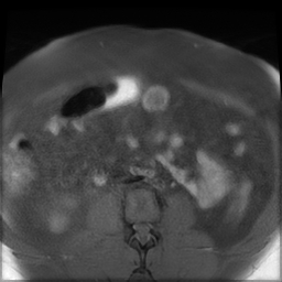File:Adenomyosis within a didelphys uterus (Radiopaedia 70175-80215 Axial T1 fat sat 3).jpg