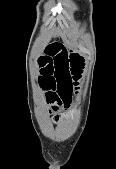 Adhesional small bowel obstruction (Radiopaedia 52107-57980 Coronal C+ portal venous phase 8).jpg