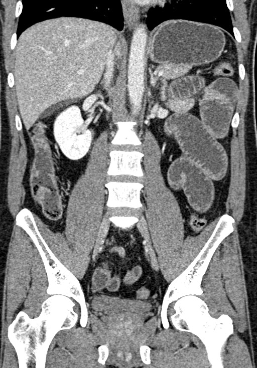 Adhesional small bowel obstruction (Radiopaedia 58900-66131 Coronal C+ portal venous phase 154).jpg