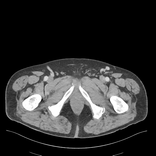 File:Adhesions within abdominal wall hernia (Radiopaedia 58283-65394 Axial C+ portal venous phase 89).png