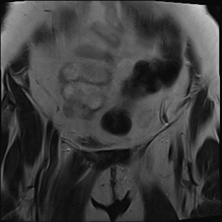 File:Adnexal multilocular cyst (O-RADS US 3- O-RADS MRI 3) (Radiopaedia 87426-103754 Coronal T2 6).jpg