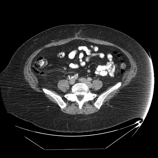 Adrenal angiosarcoma (Radiopaedia 81081-94671 Axial C+ portal venous phase 55).jpg