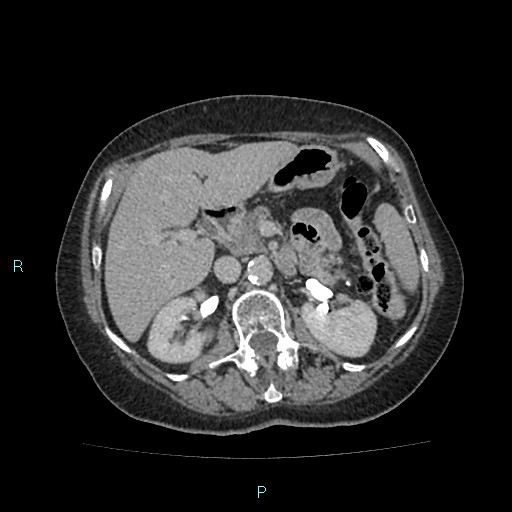 File:Adrenal collision tumor (ACT) (Radiopaedia 48462-53379 Axial C+ delayed 23).jpg