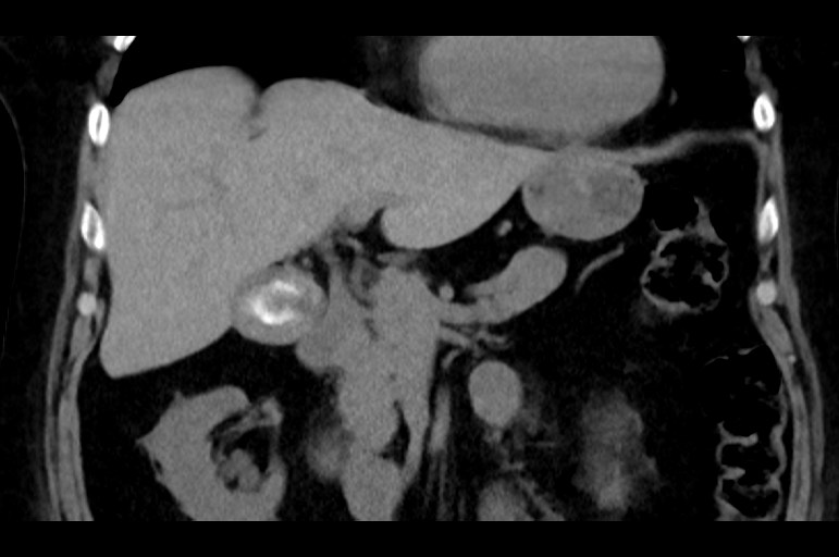 Adrenal cortical carcinoma (Radiopaedia 64017-72769 Coronal non-contrast 23).jpg