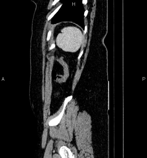 Adrenal cortical carcinoma (Radiopaedia 84882-100379 Sagittal C+ portal venous phase 79).jpg