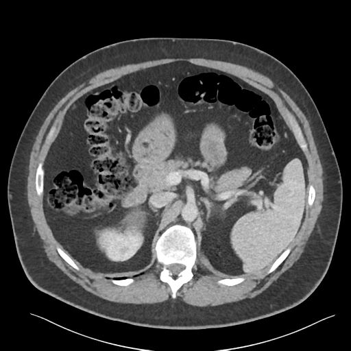 File:Adrenal cyst (Radiopaedia 45625-49777 Axial C+ portal venous phase 37).png