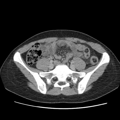 Adrenal cyst (Radiopaedia 64869-73813 Axial C+ portal venous phase 55).jpg