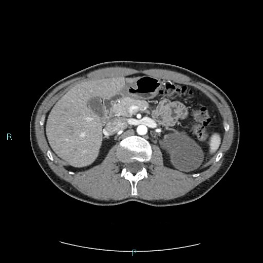Adrenal cystic lymphangioma (Radiopaedia 83161-97534 Axial C+ arterial phase 33).jpg