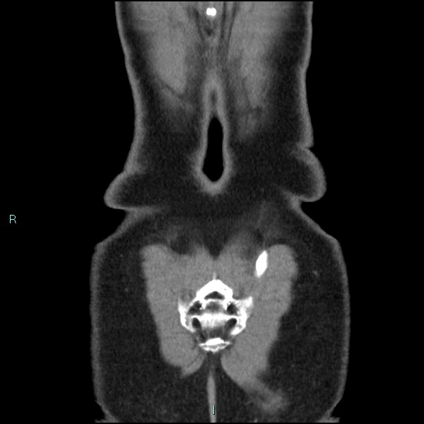 Adrenal cystic lymphangioma (Radiopaedia 83161-97534 Coronal C+ portal venous phase 75).jpg