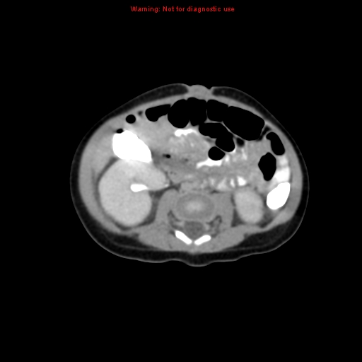 File:Adrenal hemorrhage (Radiopaedia 9390-10077 Axial C+ portal venous phase 20).jpg