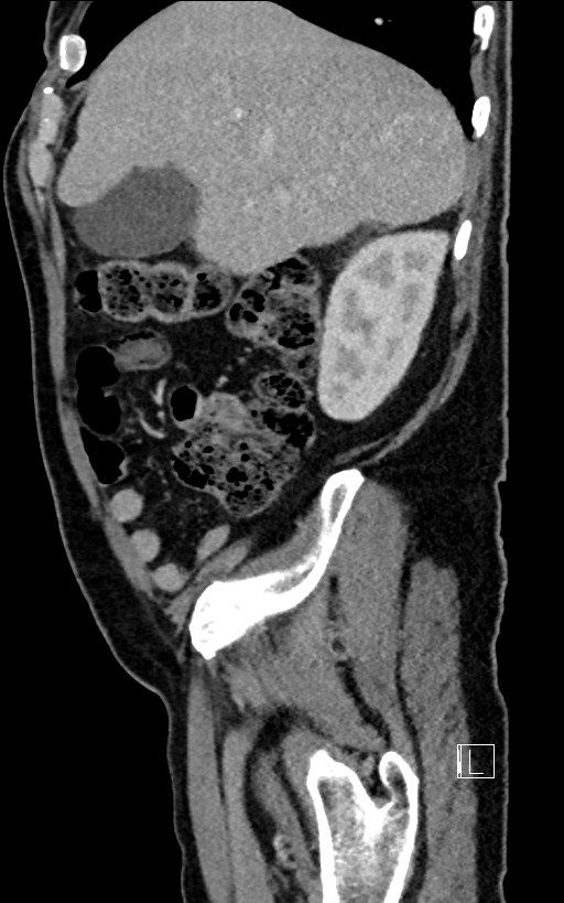 Adrenal lymphoma (Radiopaedia 73730-84529 Sagittal C+ portal venous phase 24).jpg