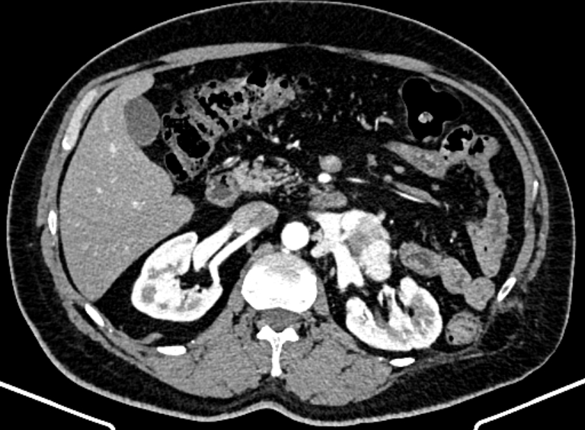 Adrenal metastases (Radiopaedia 73082-83791 Axial C+ arterial phase 69).jpg