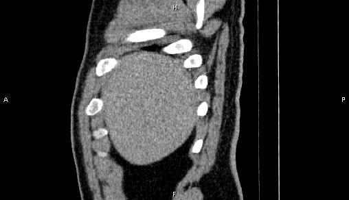 Adrenal myelolipoma (Radiopaedia 84321-99619 Sagittal non-contrast 10).jpg