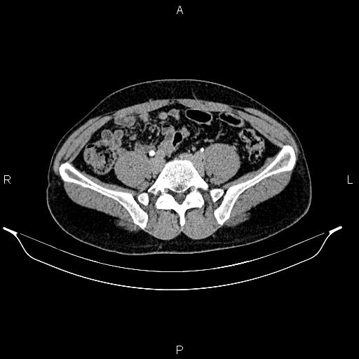 Adrenal myelolipoma (Radiopaedia 87794-104246 Axial renal excretory phase 71).jpg