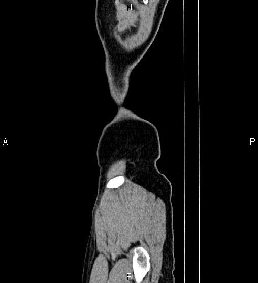 Adrenal myelolipoma (Radiopaedia 87794-104246 Sagittal renal cortical phase 98).jpg