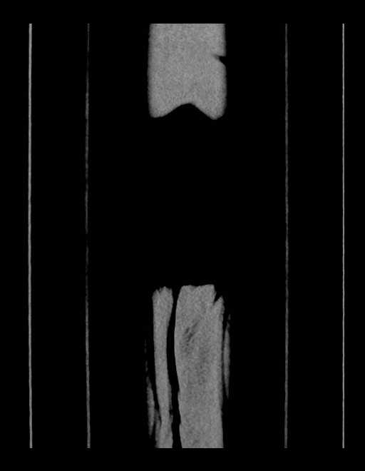 Adrenal myelolipoma - bilateral (Radiopaedia 74805-85810 Coronal C+ portal venous phase 21).jpg