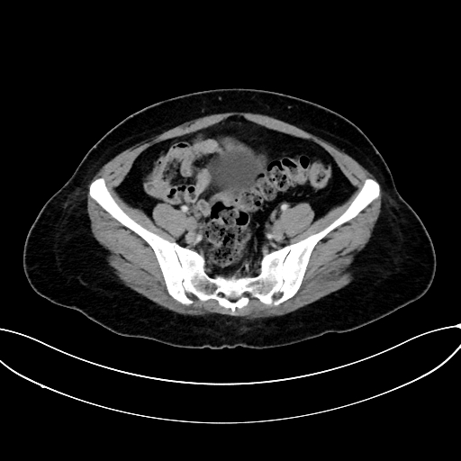Adrenocortical carcinoma (Radiopaedia 87281-103569 Axial C+ portal venous phase 67).jpg