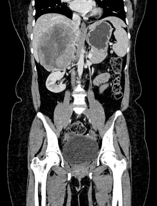 Adrenocortical carcinoma (Radiopaedia 87281-103569 Coronal C+ portal venous phase 55).jpg