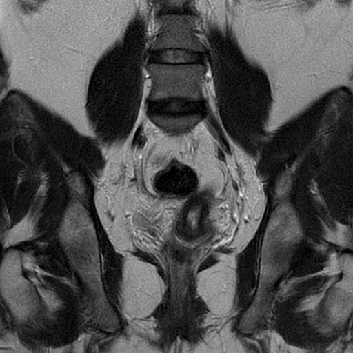 File:Adult granulosa cell tumor of the ovary (Radiopaedia 64991-73953 Coronal T2 14).jpg