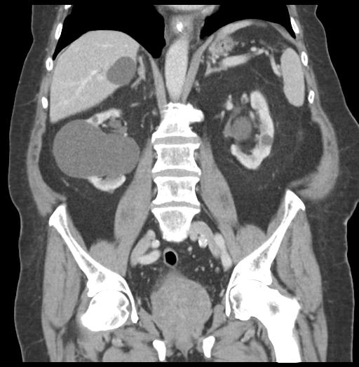Adult ileal intussusception with secondary obstruction (Radiopaedia 30395-31051 Coronal C+ portal venous phase 38).jpg