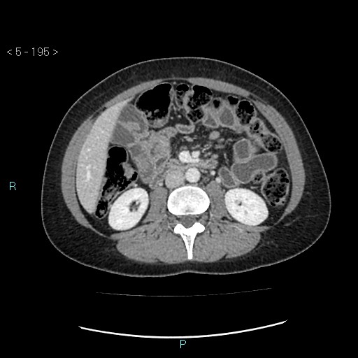 Adult transient intestinal intussusception (Radiopaedia 34853-36310 Axial C+ portal venous phase 34).jpg
