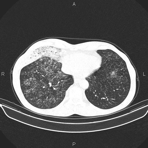 Air bronchogram in pneumonia (Radiopaedia 85719-101512 Axial lung window 51).jpg