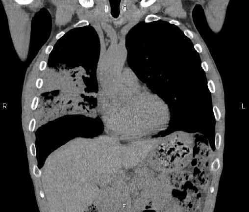 Air bronchogram in pneumonia (Radiopaedia 85719-101512 Coronal non-contrast 21).jpg