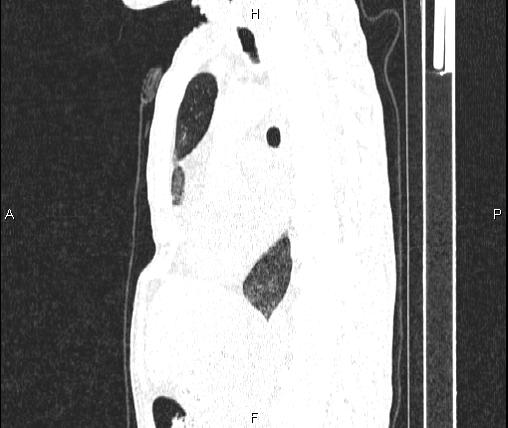 Air bronchogram in pneumonia (Radiopaedia 85719-101512 Sagittal lung window 50).jpg