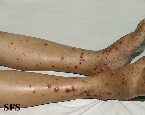 Allergic Vasculitis (Dermatology Atlas 8).jpg
