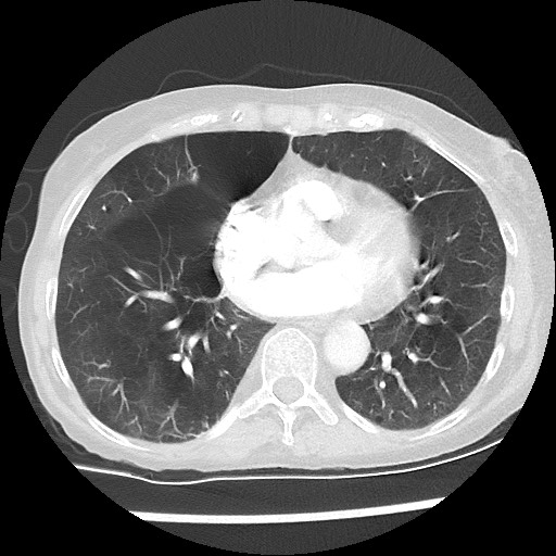 File:Alpha-1-antitrypsin deficiency (Radiopaedia 64893-73840 Axial lung window 34).jpg
