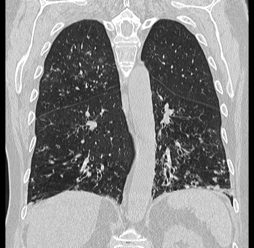 File:Alpha-1-antitrypsin deficiency (Radiopaedia 72058-82557 Coronal lung window 64).jpg