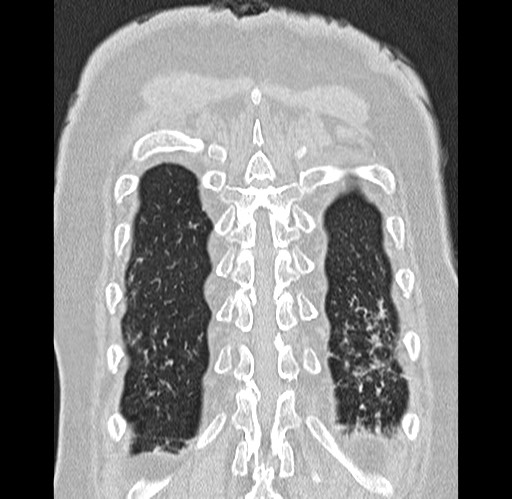 Alpha-1-antitrypsin deficiency (Radiopaedia 72058-82557 Coronal lung window 92).jpg