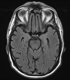 File:Alzheimer's disease- with Gerstmann syndrome and dressing apraxia (Radiopaedia 54882-61150 Axial FLAIR 10).png
