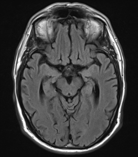 File:Alzheimer's disease- with Gerstmann syndrome and dressing apraxia (Radiopaedia 54882-61150 Axial FLAIR 11).png