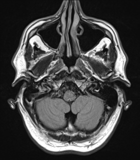 File:Alzheimer's disease- with Gerstmann syndrome and dressing apraxia (Radiopaedia 54882-61150 Axial FLAIR 3).png