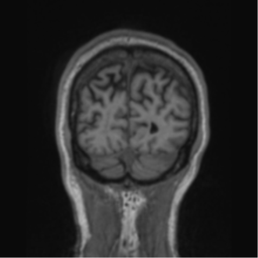 File:Alzheimer's disease- with apraxia (Radiopaedia 54763-61011 Coronal T1 17).png