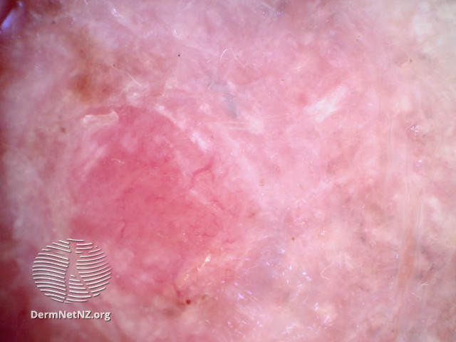 File:Amelanotic melanoma dermoscopy (DermNet NZ amelanotic-melanoma2).jpg