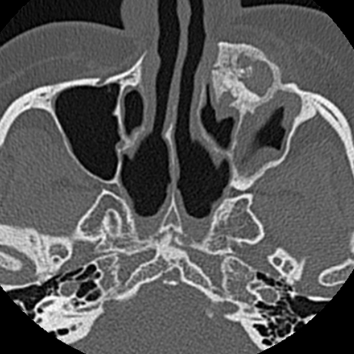 File:Ameloblastic fibro-odontoma (Radiopaedia 18843-18780 C 17).jpg