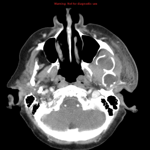 Ameloblastoma (Radiopaedia 27437-27631 A 19).jpg