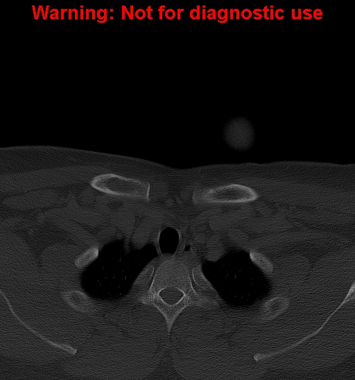 File:Ameloblastoma (Radiopaedia 33126-34164 Axial bone window 50).jpg