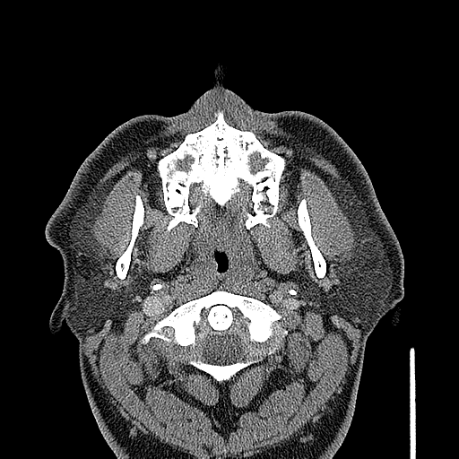 Ameloblastoma (Radiopaedia 33677-34806 Coronal non-contrast 1).png