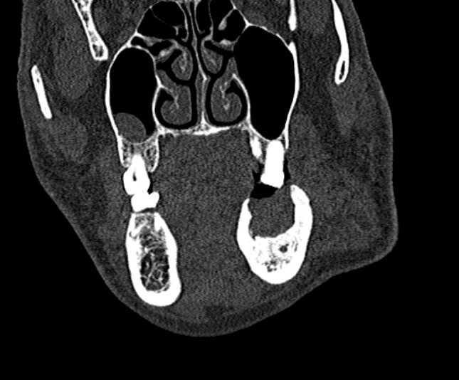 Ameloblastoma (Radiopaedia 51921-57766 Coronal bone window 77).jpg