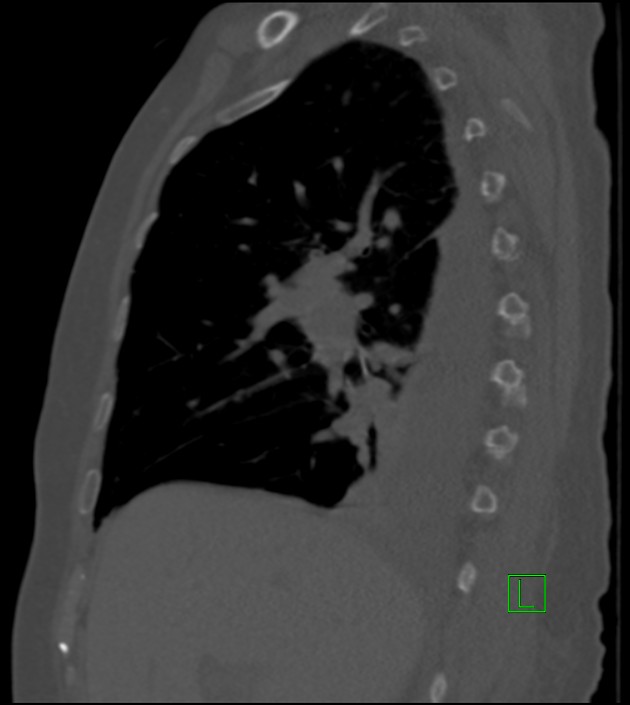 Amiodarone deposition in the liver (Radiopaedia 77587-89780 Sagittal bone window 65).jpg
