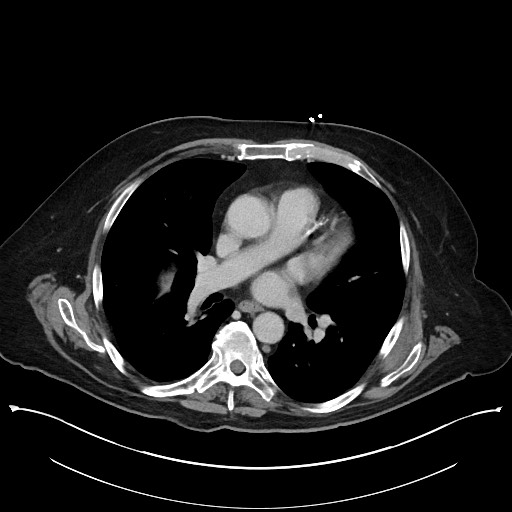 Ampullary adenocarcinoma (Radiopaedia 59373-66737 A 6).jpg